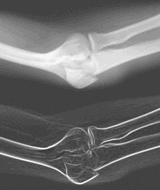 Image of Elbow X-ray